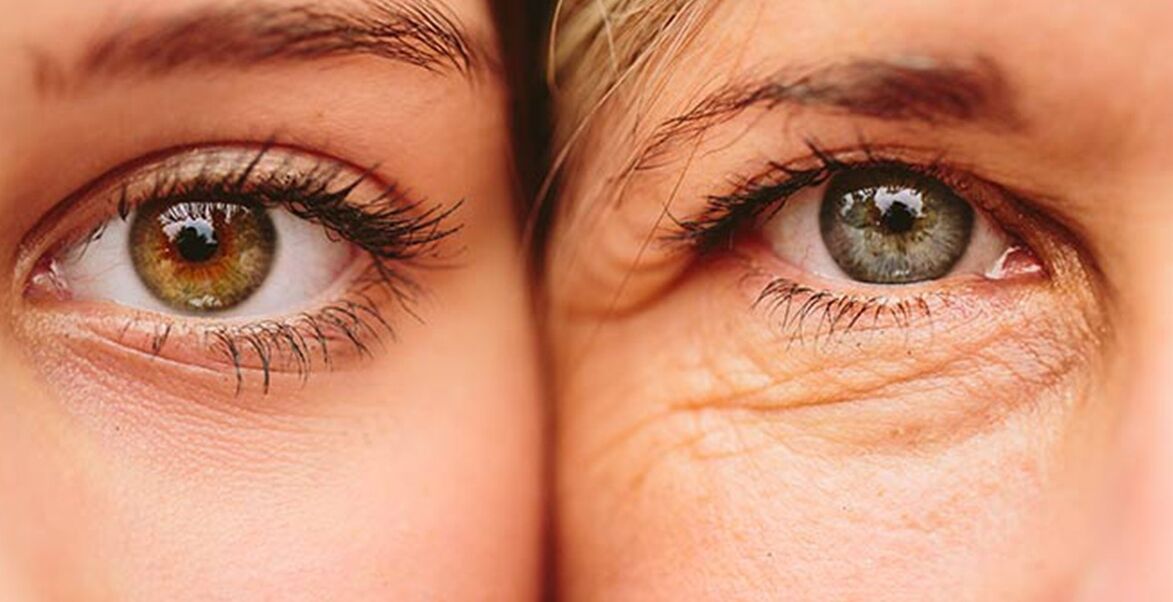 External signs of aging of the skin around the eyes in two women of different ages