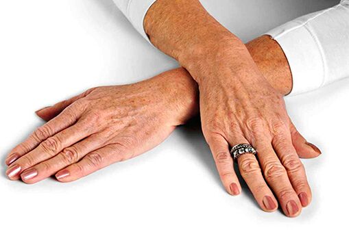 The skin of the hand with age-related changes requires the use of rejuvenation techniques