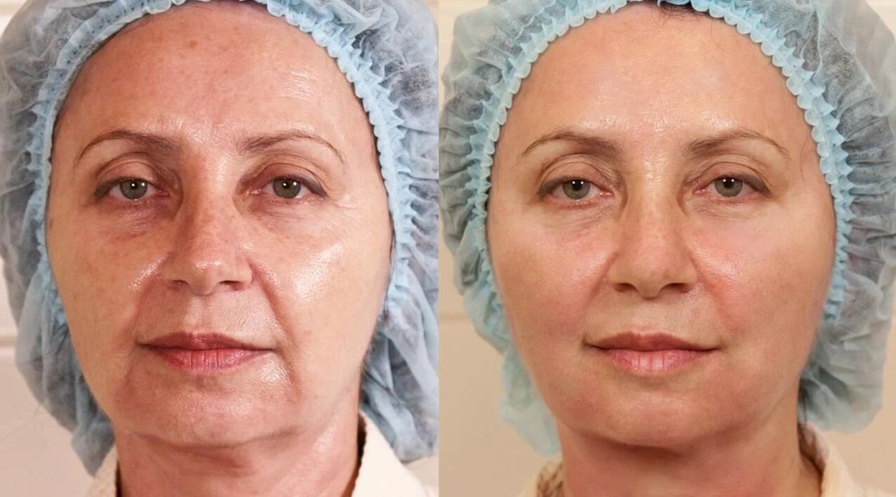 Before and after facelift pictures