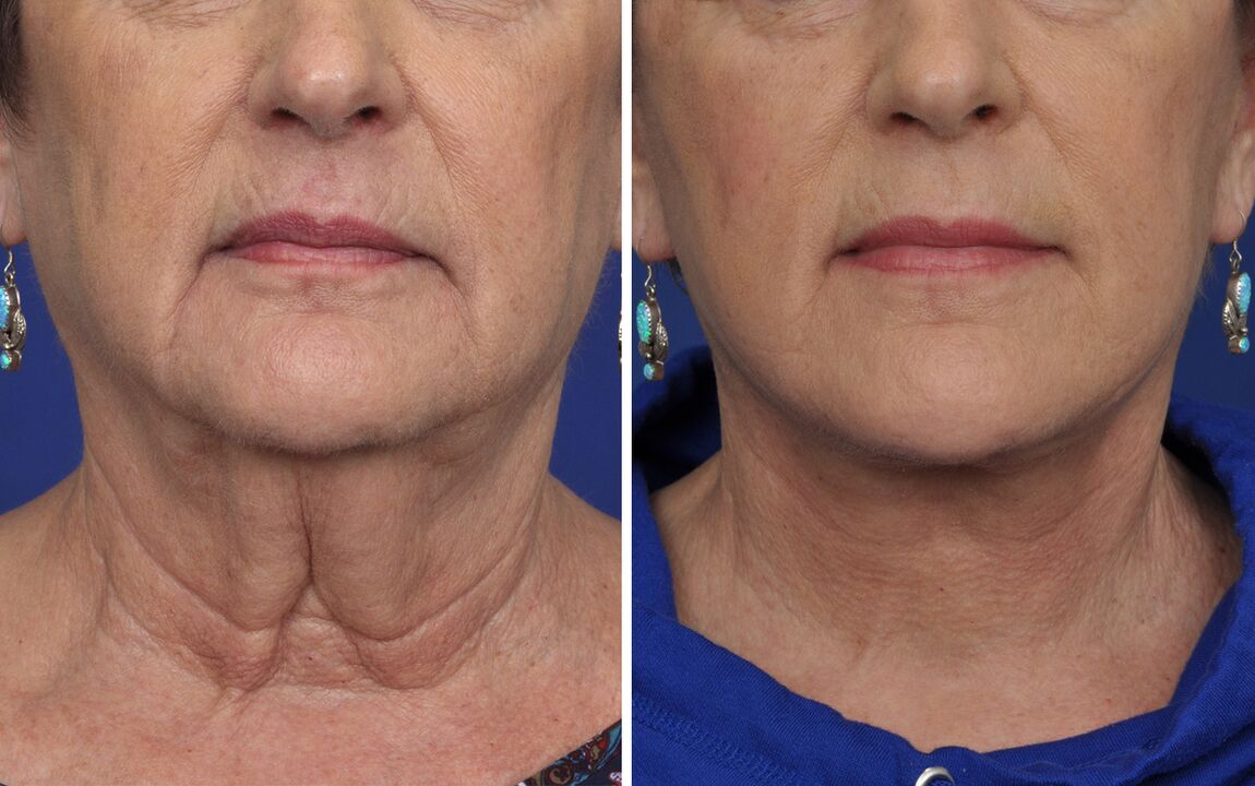 Before and after skin rejuvenation procedures