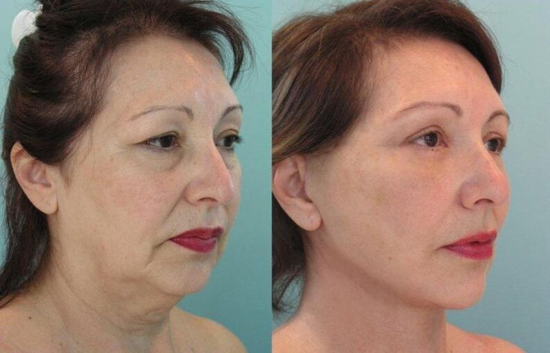 Facial skin tightening with threads results in rejuvenation