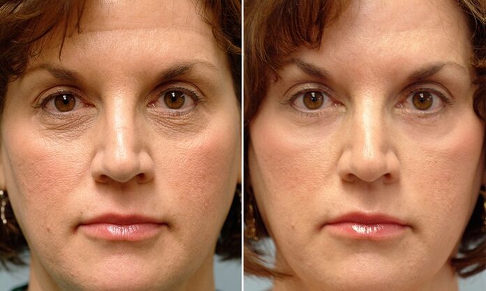 Face before and after laser fractional rejuvenation