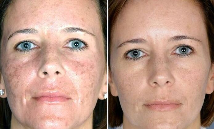 Photograph before and after fractional laser rejuvenation